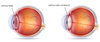 Cataracte