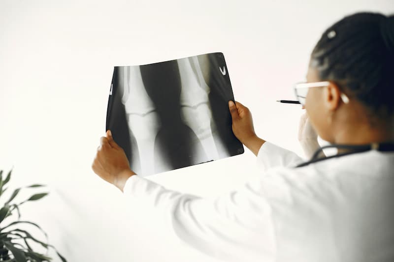 L'arthrose entraine une perte en épaisseur du cartilage