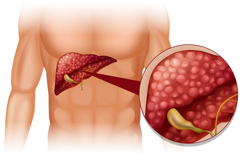Constipation chronique : importance de la bile